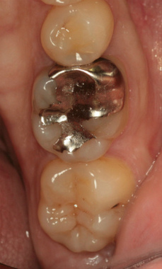 銀歯 2014年2月アーカイブ - EE DENTAL_Blog
